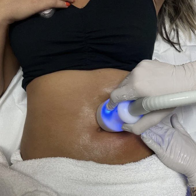 Smart Cryo body contouring treatment on the abdomen