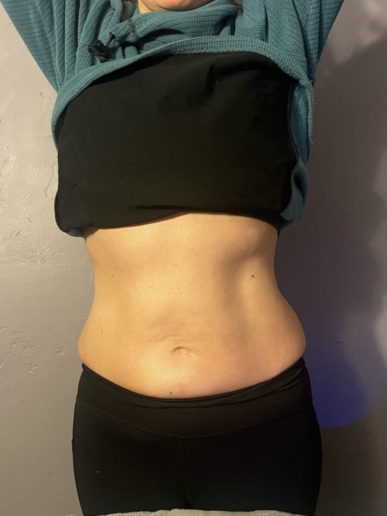 Abdomen after Smart Cryo treatment