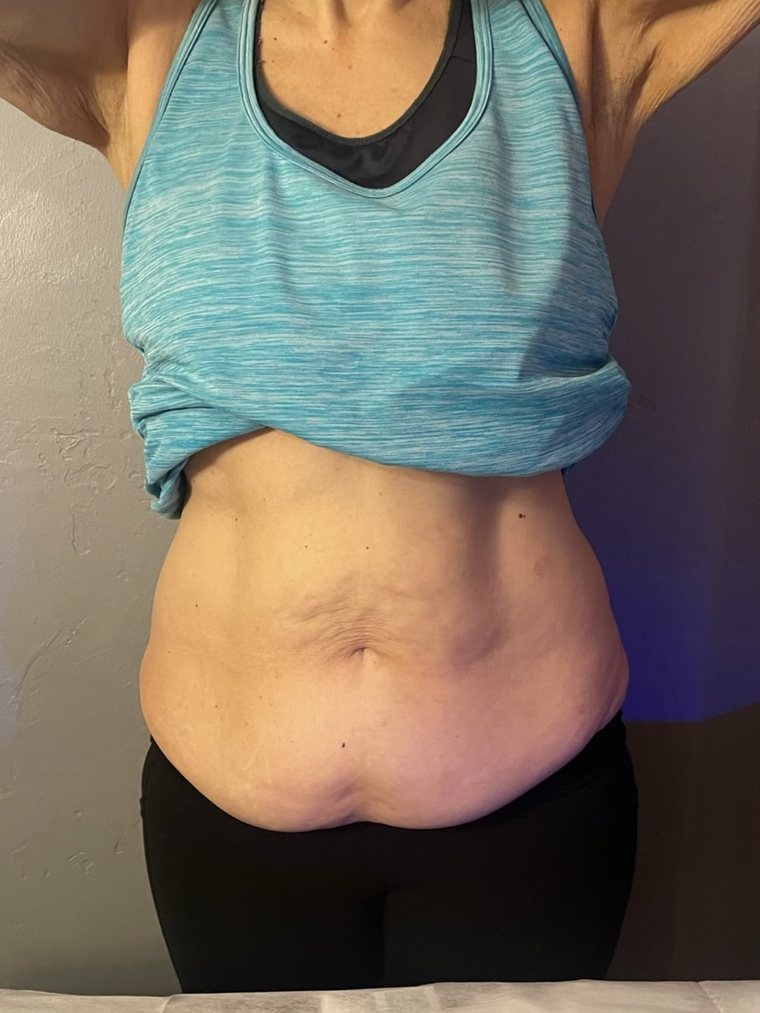 Abdomen before Smart Cryo treatment