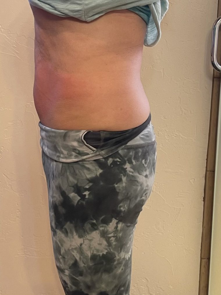 Waist and flank after Smart Cryo treatment