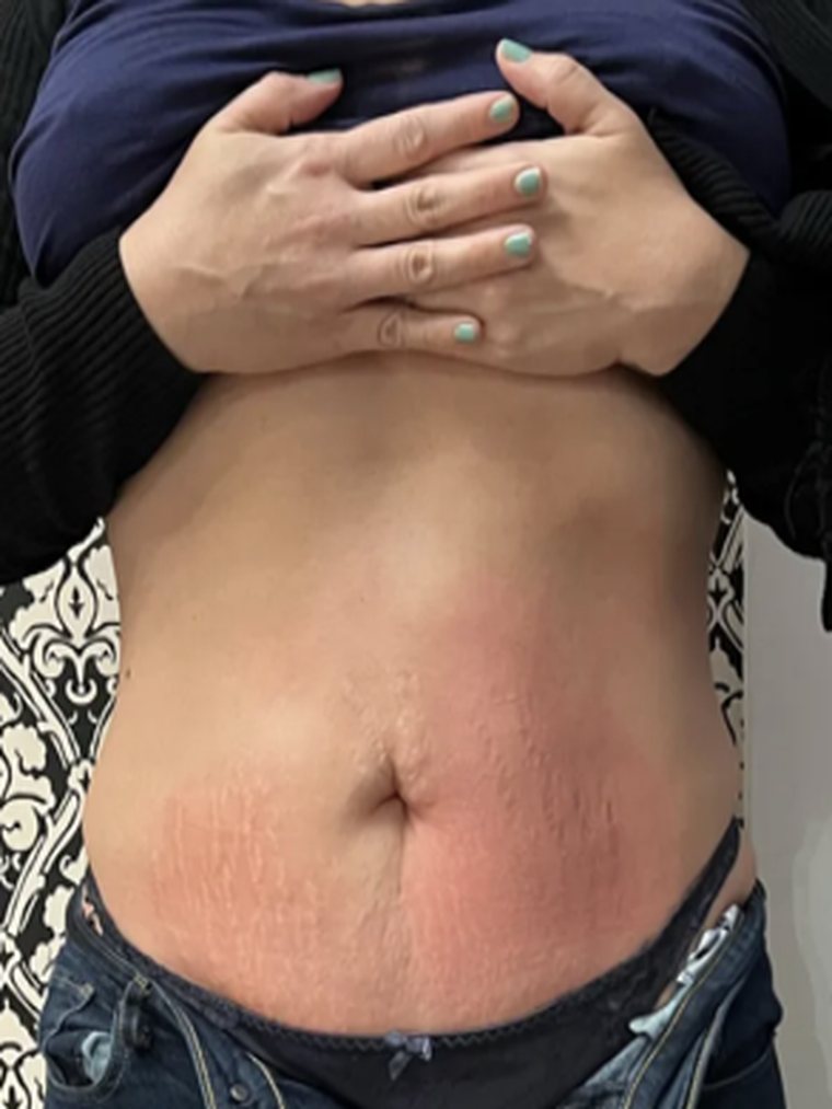 Abdomen after Cryo Toning