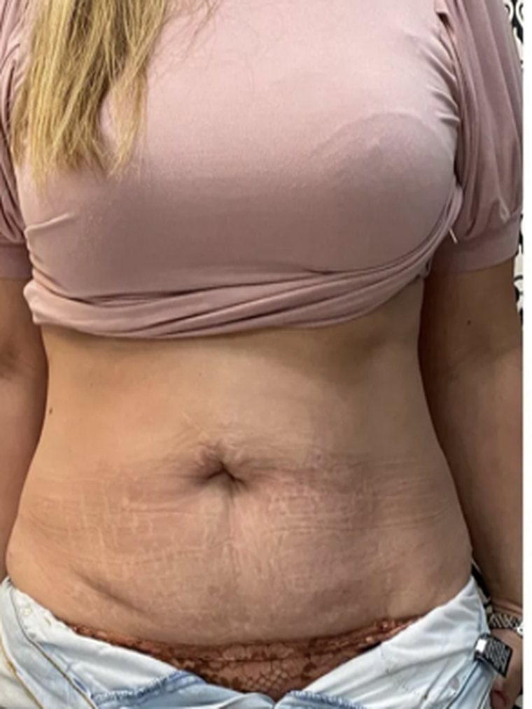 Abdomen before Cryo Toning
