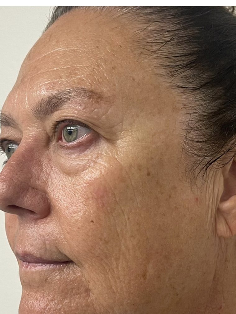 Face and jawline after Cryo Facial