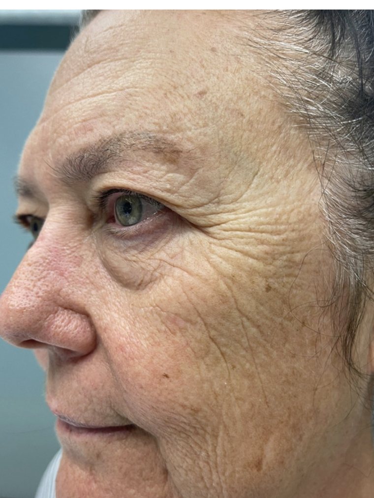 Face and jawline before Cryo Facial