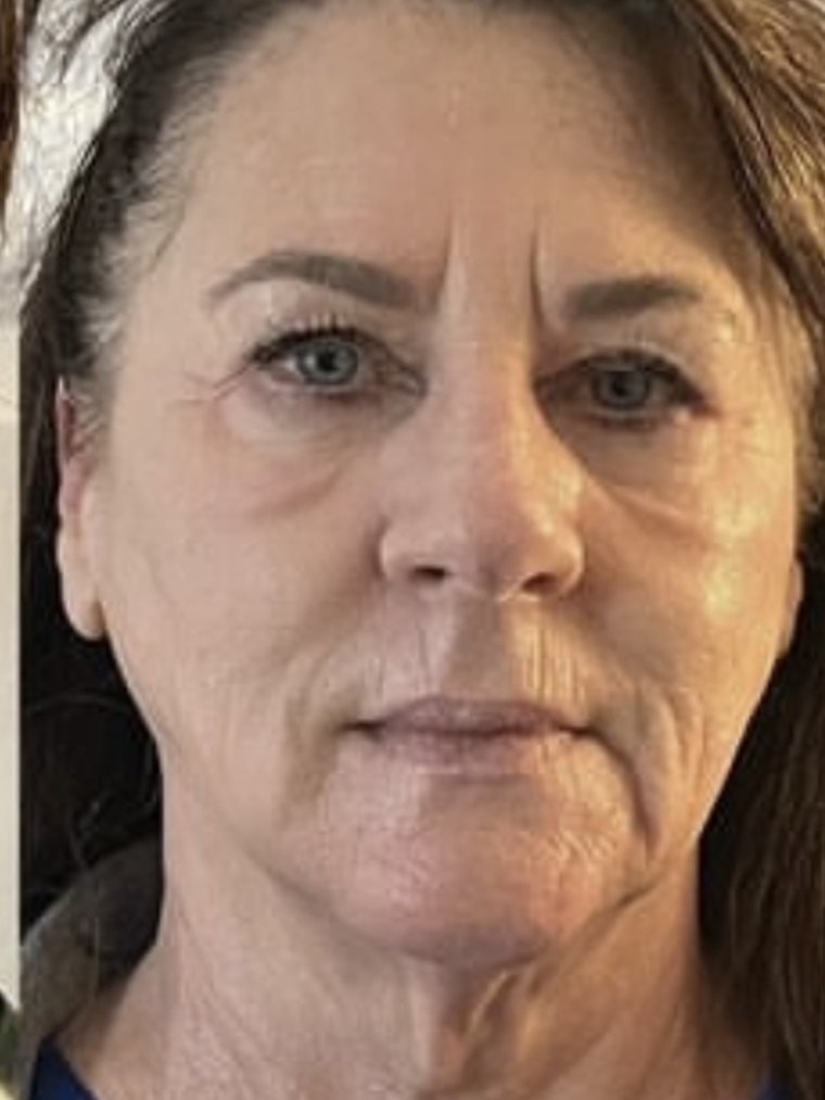 Face and neck after Cryo Facial