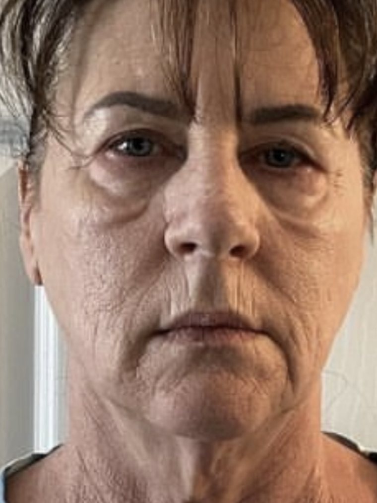 Face and neck before Cryo Facial